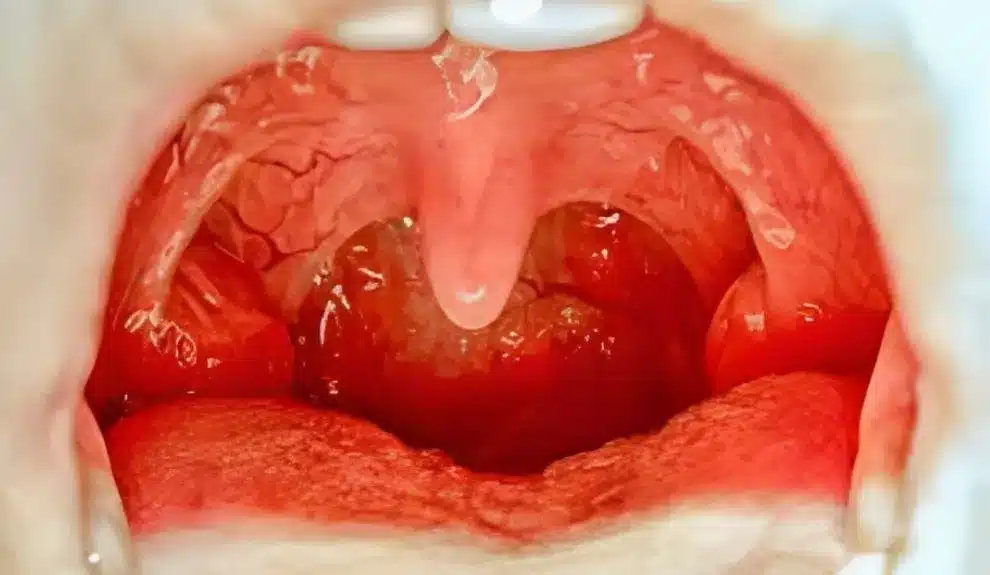 Can Tonsils Grow Back After Being Removed? – tymoff